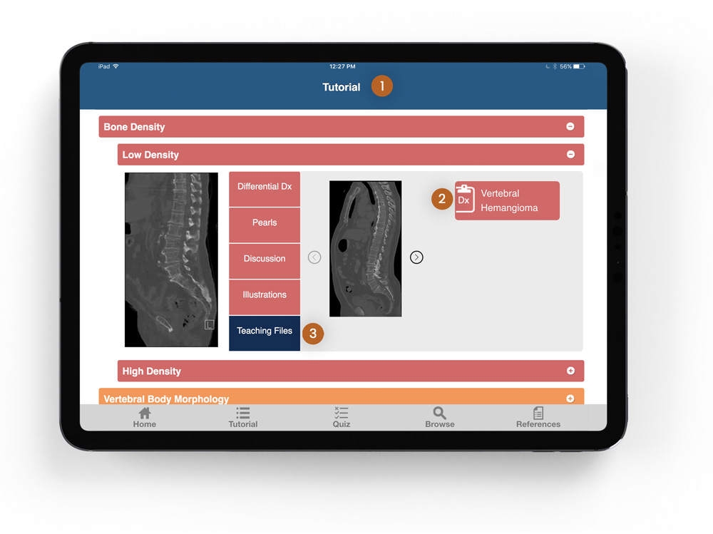 ctisus l-spine pathology app's old tutorial page on an ipad with Differential diagnosis, pearls, and discussion scans and three numbers pointing out the key insights