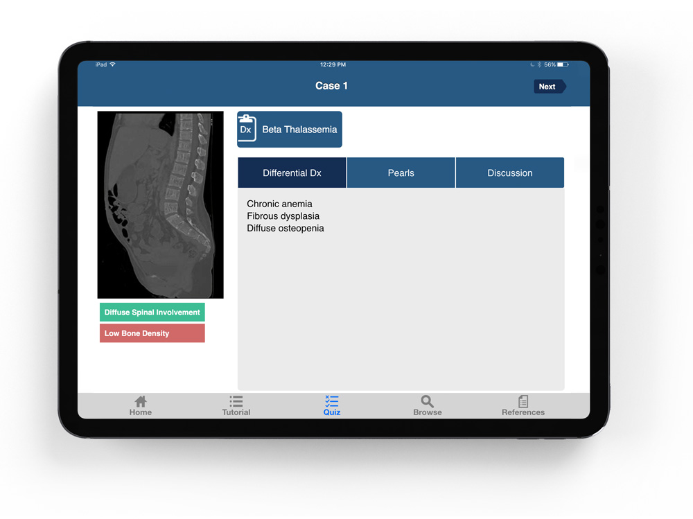 ctisus l-spine pathology app's old quiz page on an ipad showing Differential diagnosis, pearls, and discussion scans on Beta Thalassemia